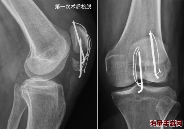 可不可以干湿你顾青州骨科顾青州手术顺利结束术后恢复良好已拆线开始康复训练