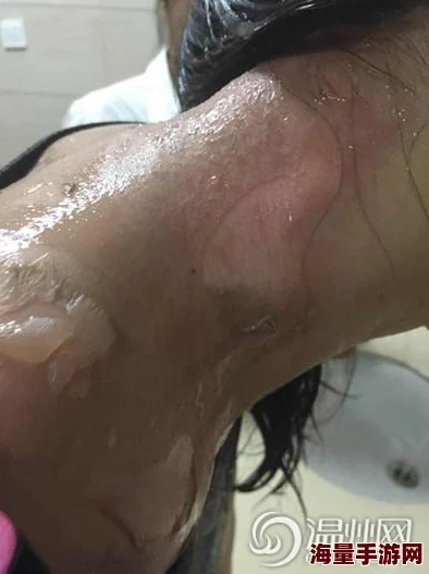 扯开用筷子烫肉蒂听说隔壁王嫂也这样弄结果烫伤了现在天天抹芦荟胶 扯开用筷子烫肉蒂听说隔壁王嫂也这样弄结果烫伤了现在天天抹芦荟胶